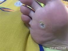 拓疣涂什么药膏